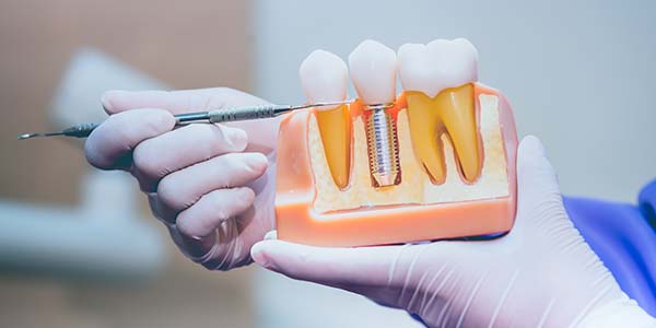 Dentures vs Dental Implants: What's the Difference? | Smile Dental