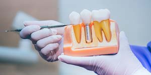 Dentures vs Dental Implants: What's the Difference? | Smile Dental